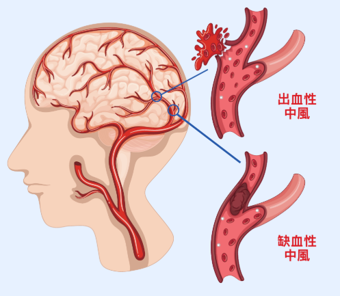 高齡老人跑贏黃金4.5小時丨德州市中醫(yī)院專家：別讓腦卒中，“卒”不及防