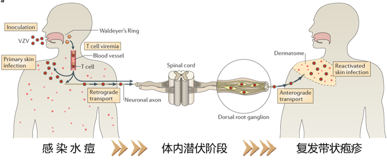 有一種痛叫帶狀皰疹神經(jīng)痛，你了解嗎？