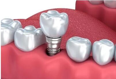 國家醫(yī)保局：暫未考慮將種植牙納入醫(yī)保