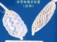 中國學者研發(fā)食管癌篩查新方法 “膠囊”采集細胞助患者早診早治