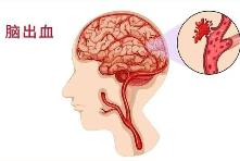 腦出血2小時內強化降壓 可減少致殘致死風險